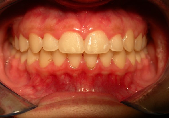 After image