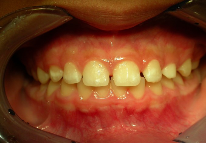 After image