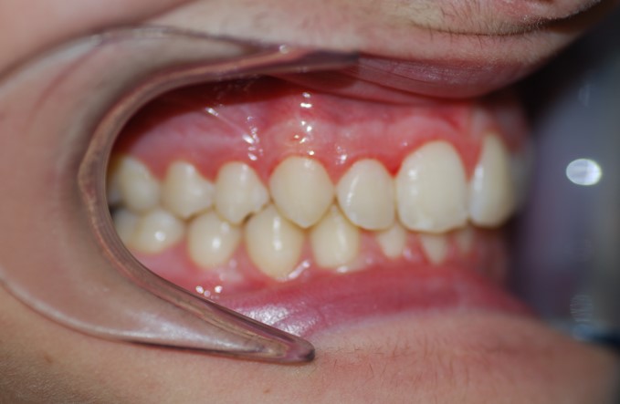 After image