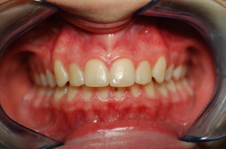 After image