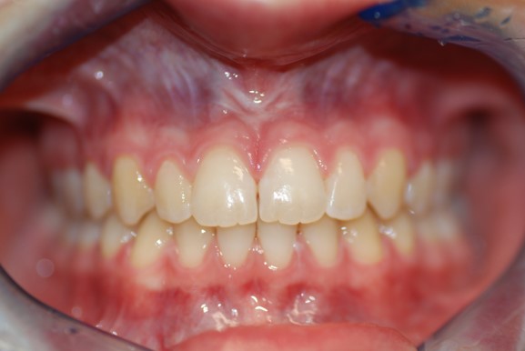 After image