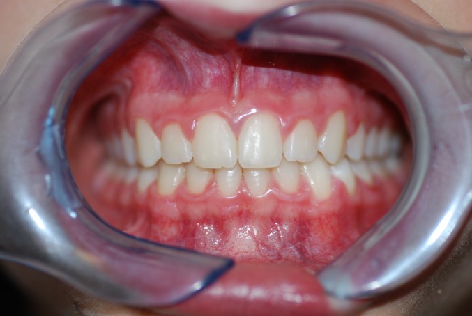 After image